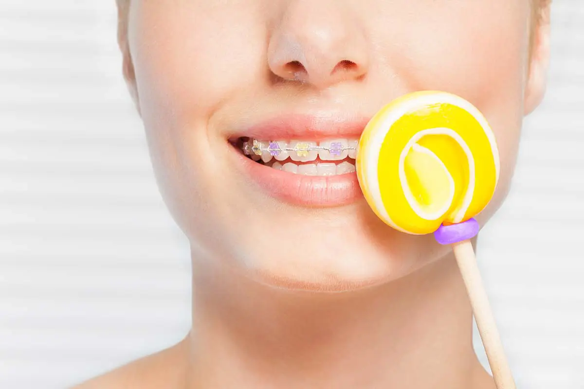 top-5-worst-candies-to-eat-with-braces-ricci-orthodontics