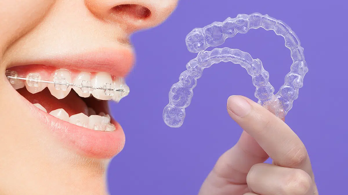 Invisalign Vs. Braces Which Is For You? Ricci Orthodontics